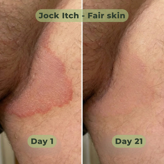 BoomJude Antifungal Soap